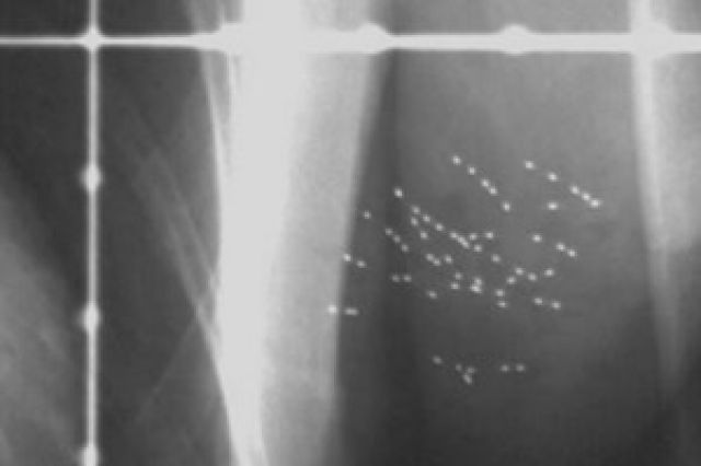 Hạt phóng xạ có thể điều trị tận gốc bệnh ung thư vú